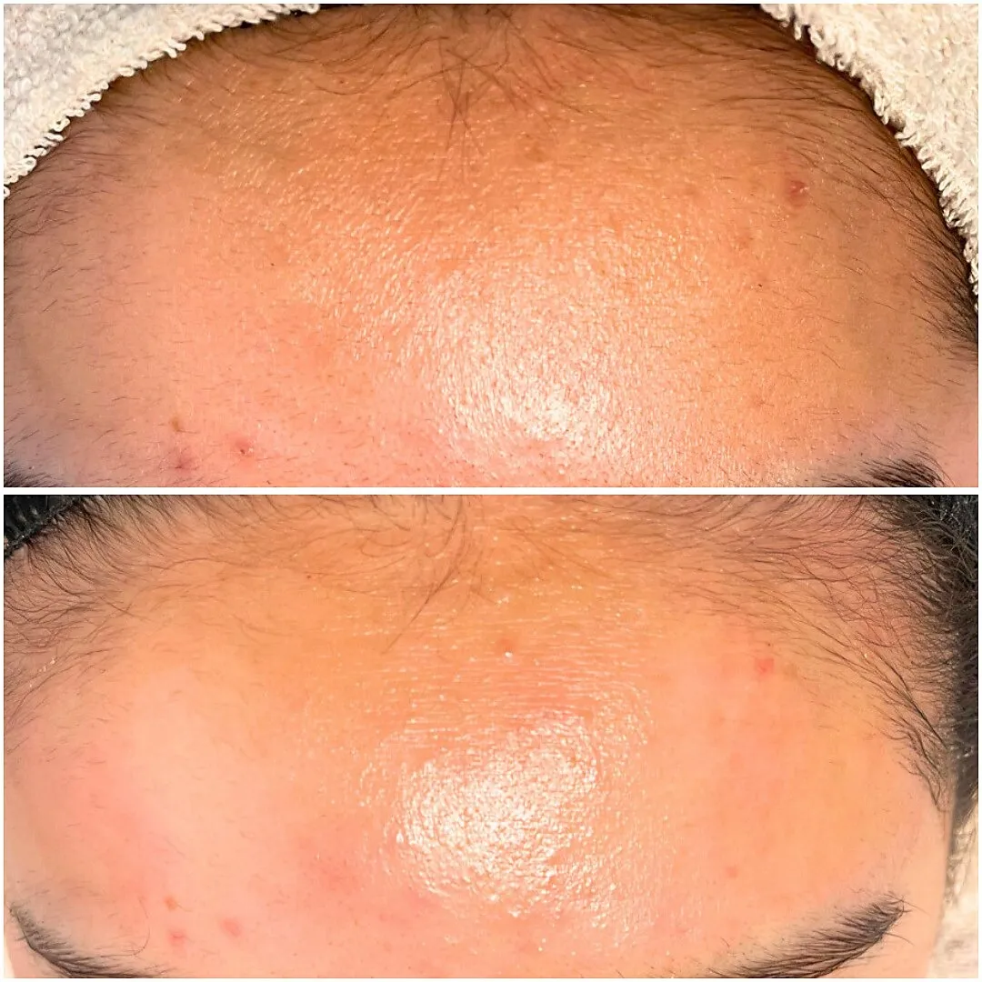  思春期の肌荒れも育菌で改善！