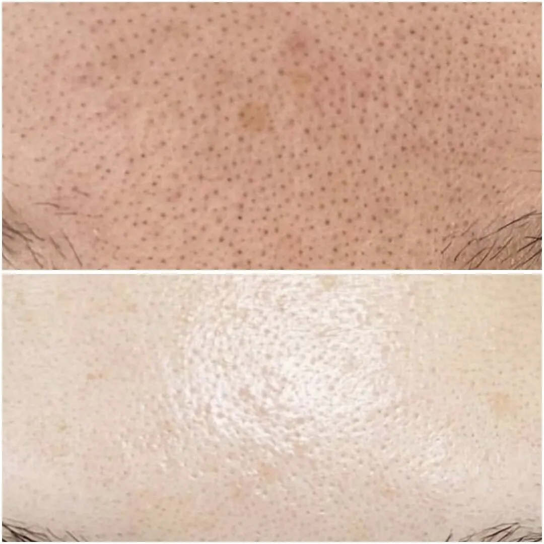  毛穴黒ずみ改善！