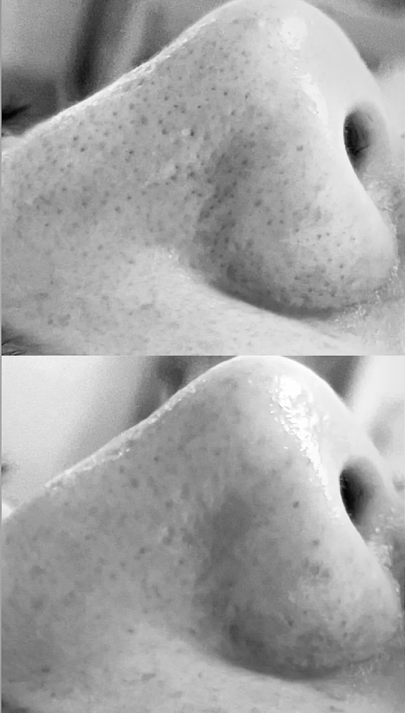 エステで叶える福岡県北九州市の毛穴の悩み解消と安全なマツヤニホットセラピー体験