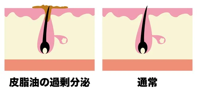 皮脂の過剰分泌