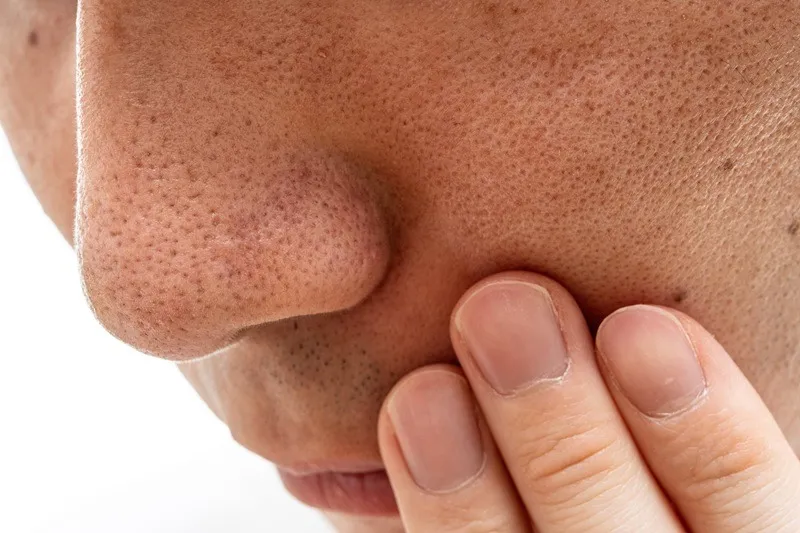 【メンズ必見】いちご鼻の治し方完全ガイド｜原因から改善法まで徹底解説