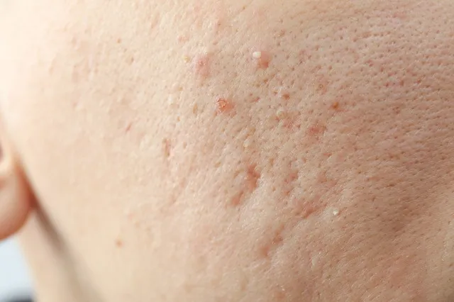 顔ダニの症状と見分け方｜肌荒れとの違いをチェックリストで解説