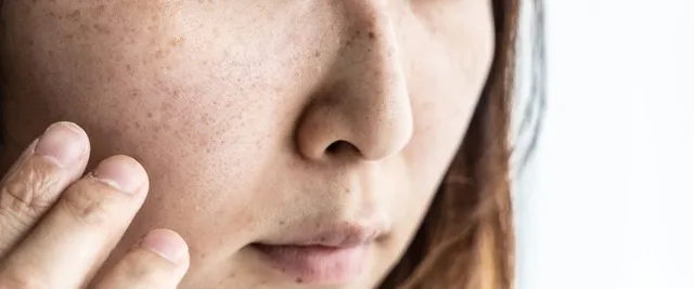 頬の毛穴黒ずみの取り方完全ガイド｜原因別の正しいケア方法